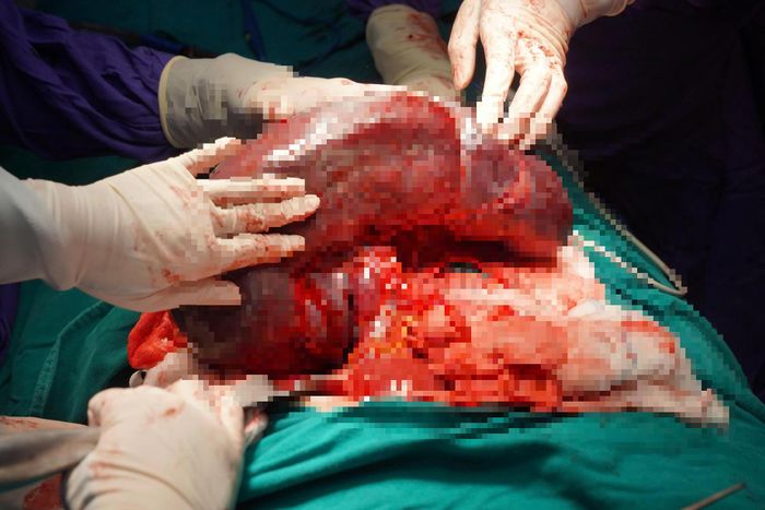 Lá lách có trọng lượng 3,5kg, gấp 20 lần bình thường.