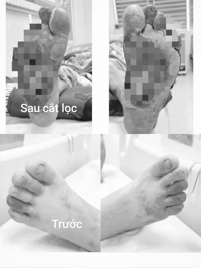 Mất nhiều đốt ngón chân vì chủ quan với vết xước nhỏ - Ảnh BVCC