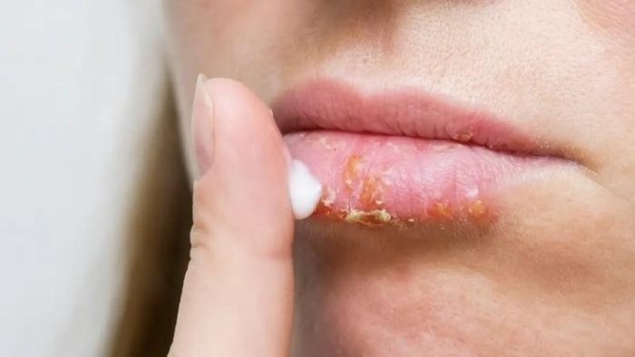 Hãy tẩy tế bào chết và bôi son dưỡng hàng ngày để môi luôn mịn màng, căng mọng. Ảnh minh họa