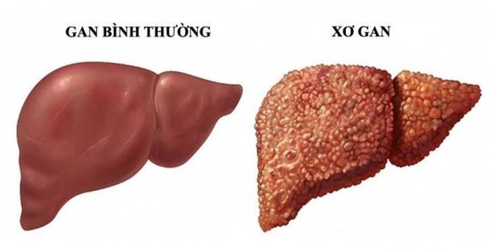 Người bị xơ gan nên được tầm soát định kỳ, ngay cả khi chưa có triệu chứng. 