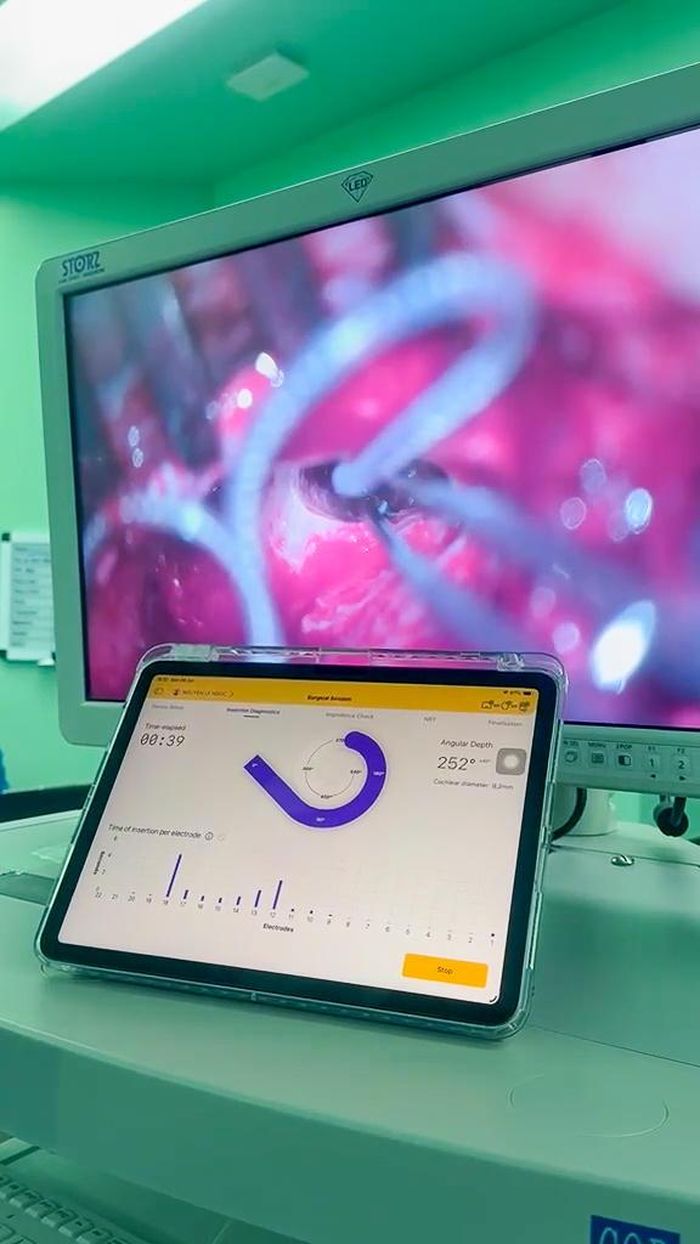 Hình ảnh điện cực đang được đặt vào ốc tai, với sợ hỗ trợ của các thiết bị hiện đại giúp đánh giá quá trình luồn điện cực như tốc độ, góc đặt điện cực (Ảnh: BV ĐHYD)