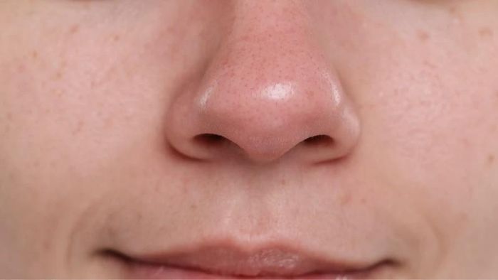 Một trong những nguyên nhân dẫn tới tình trạng mụn đầu đen đó là làm sạch da chưa đúng cách. Ảnh minh họa