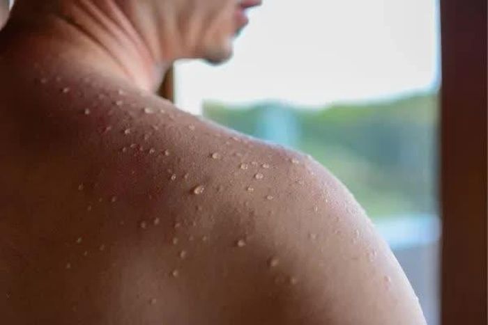 Mồ hôi ban đêm kéo dài cần được lưu ý. Ảnh minh họa