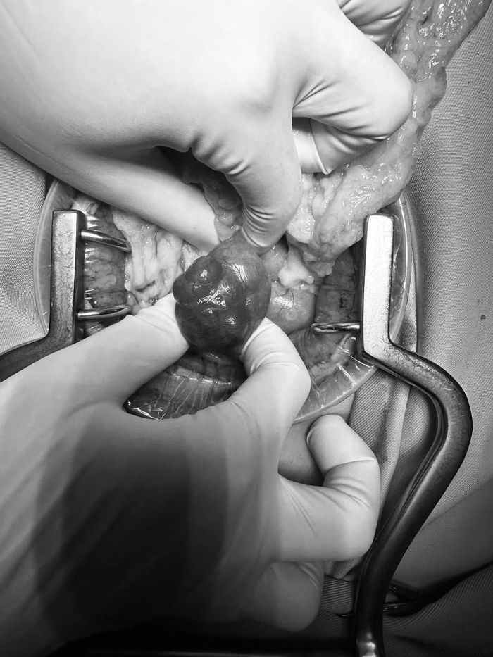 Khối u 3 cm được bóc tách thành công - Ảnh BVCC