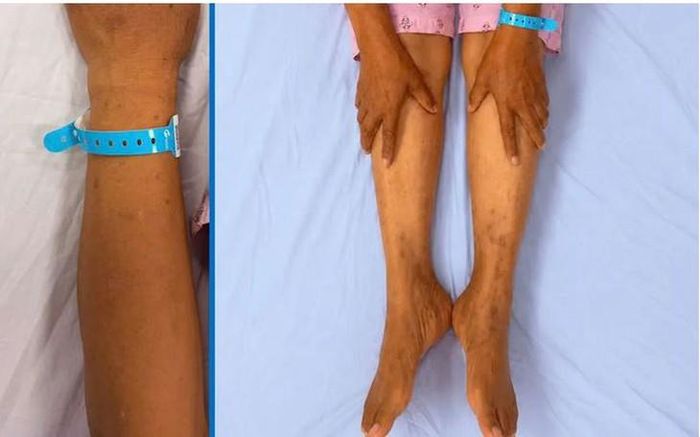 Biểu hiện tổn thương gan của bệnh nhân. Ảnh: BV TW QĐ 108