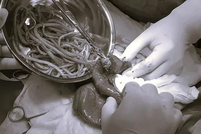 Bác sĩ gắp ra nhiều giun trong ruột bệnh nhi. Ảnh minh họa: Bệnh viện Nhi đồng 2.