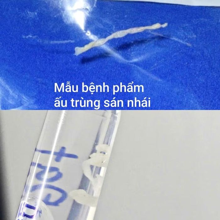 Mẫu bệnh phẩm của bệnh nhân.