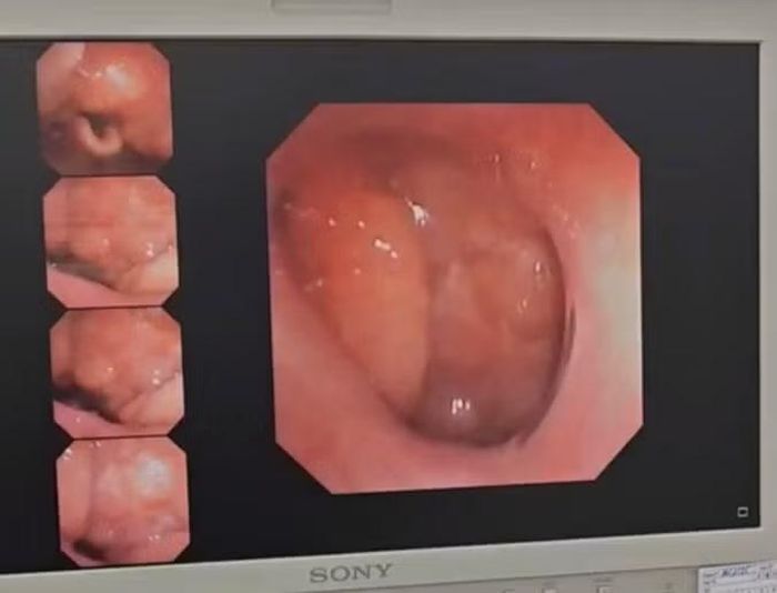 Tình trạng VA gờ vòi, mô lympho tăng sinh và sụp cơ gần như hoàn toàn khi ngủ - Ảnh BVCC
