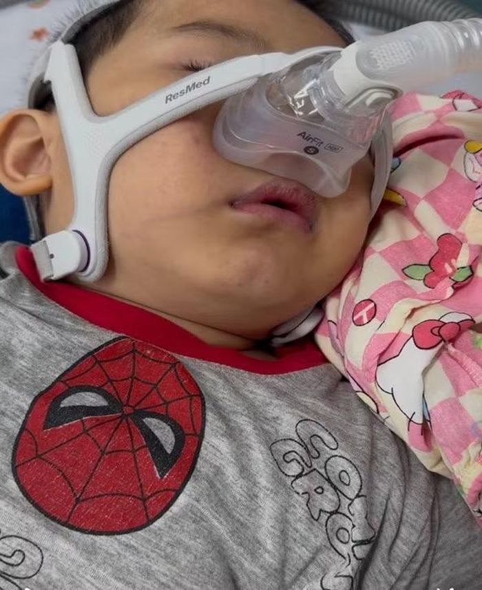 Bệnh nhi được thở máy BiPAP (áp lực dương không xâm lấn) tại Khoa Hô hấp, Bệnh viện Nhi đồng 1 - Ảnh BVCC