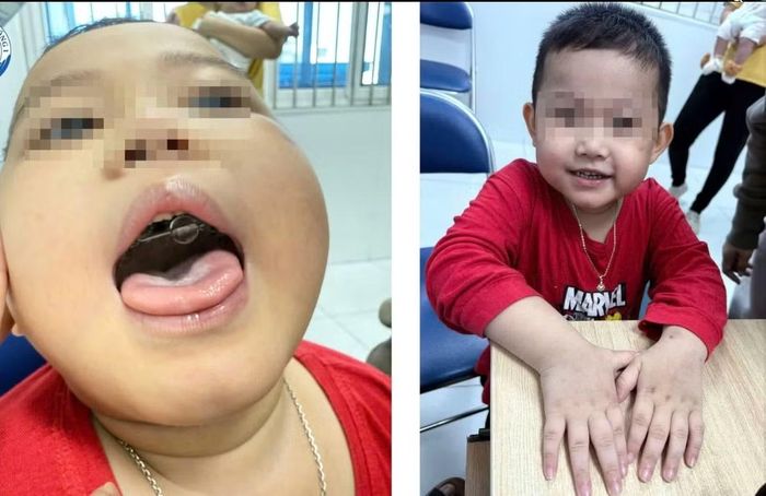 Bé N. tại buổi tái khám sau 1 tháng điều trị: hồng hào, tươi tắn, không còn tình trạng tím tái. Bé đã được các bác sĩ can thiệp đặt khí cụ nới rộng hàm trên - Ảnh BVCC