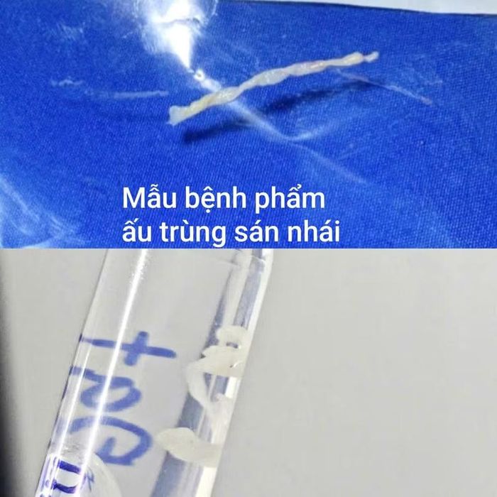 Mẫu bệnh phẩm ấu trùng sán nhái hiếm gặp. Ảnh: Minh Thanh.