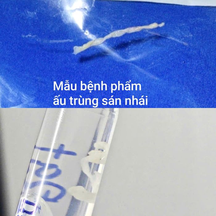 Ấu trùng sán nhái được gắp ra từ khối u trên đùi của bệnh nhân.