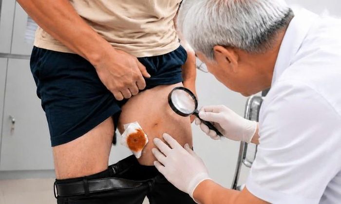 Vùng tổn thương ở bệnh nhân sau khi rạch lấy ấu trùng sán nhái. Ảnh: BVCC