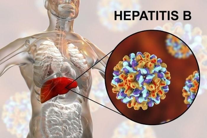Viêm gan virus là nguyên nhân gây ung thư gan. Ảnh: WHO.