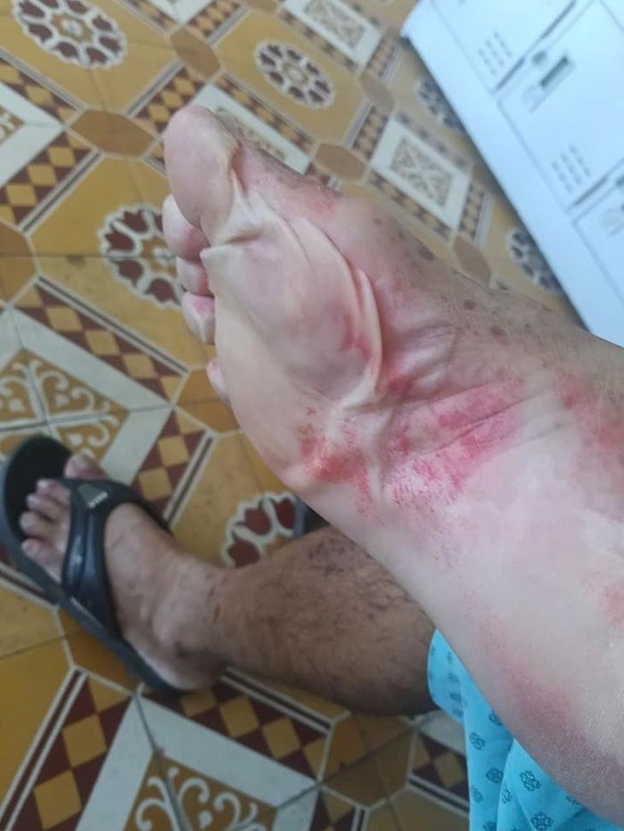 Bệnh nhân bị dị ứng nặng sau dùng thuốc nhỏ mắt. Ảnh: BVCC.