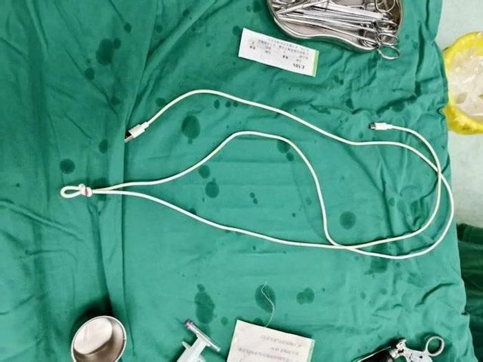 Một sợi dây cáp sạc, đường kính khoảng 6mm và dài 80cm, được lấy ra khỏi niệu đạo của bệnh nhân. Ảnh: HK01