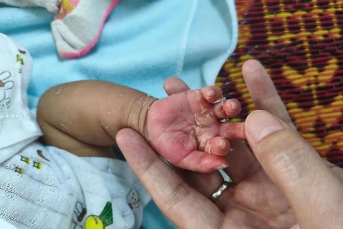  Da trẻ bong tróc vì bị giang mai. Ảnh: BVCC. 