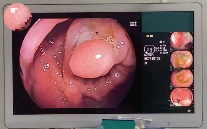 Đa polyp đại tràng - Ảnh BVCC