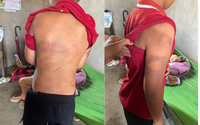 Những vết thương trên cơ thể cháu N.T.U. sau những trận đòn roi của người bố