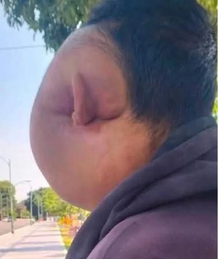 Một bên khuôn mặt của Pu sưng phồng rõ rệt, làm diện mạo thay đổi và ảnh hưởng lớn đến cuộc sống hằng ngày. Ảnh: Khaosod