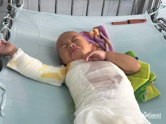 Nhiều vùng cơ thể của bé Nhân được băng kín do tổn thương bỏng