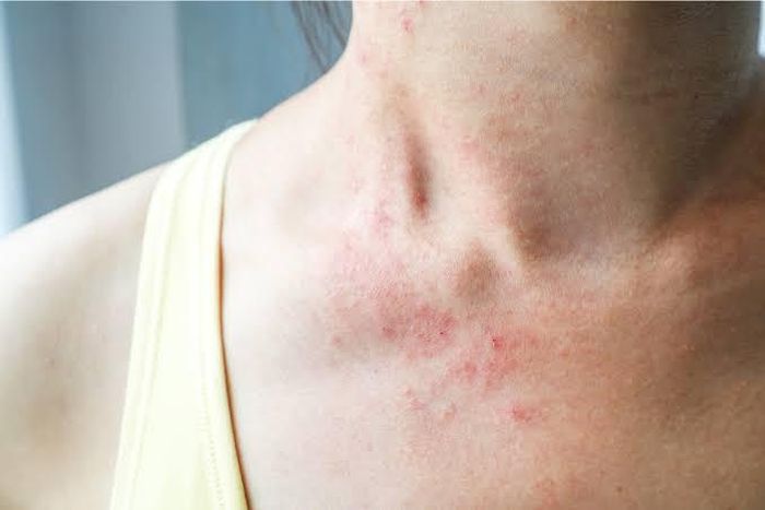 Da có thể bị kích ứng. Ảnh minh họa.