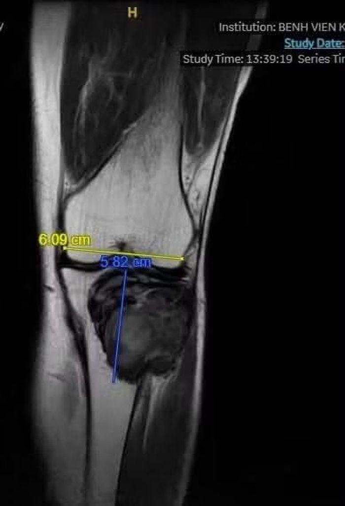 U xương khổng lồ trên phim chụp - Ảnh BVCC