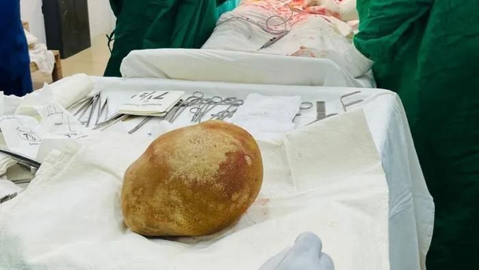 Viên sỏi bàng quang có đường kính khoảng 17cm, kích thước bằng một quả trứng đà điểu (Ảnh: BBC) 
