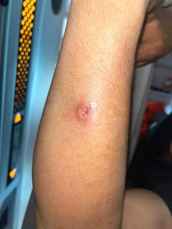 Vùng tổn thương trên cánh tay anh N.V.T. đã khô. Hình ảnh chụp ngày 19/8/2026.