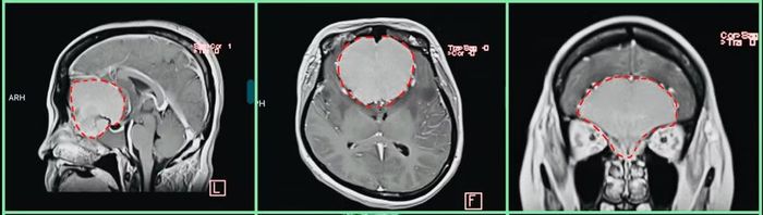 Hình ảnh khối u khổng lồ vùng rãnh khứu trên phim MRI sọ não. Ảnh BV 115