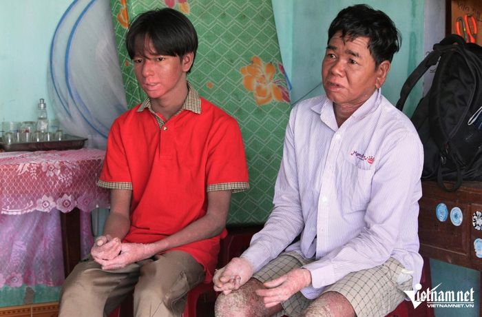 Căn bệnh lạ khiến chân tay của 2 cha con Vương co quắp, toàn thân xuất hiện nhiều vảy sừng cứng và liên tục lột da như rắn rất đau đớn.