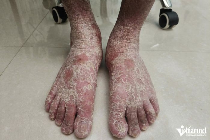 Căn bệnh về da ảnh hưởng rõ đến tay, chân và khả năng đi lại của Vương.