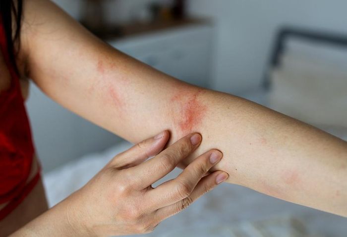 Dị ứng nặng khiến người bệnh khó thở, sốc phản vệ. Ảnh: Shutterstock.