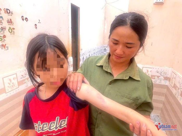 Gió rít mạnh, hất văng chiếc ghế va trúng cháu K.N. khiến cánh tay cháu bị thâm tím. Ảnh: Trần Hoàn