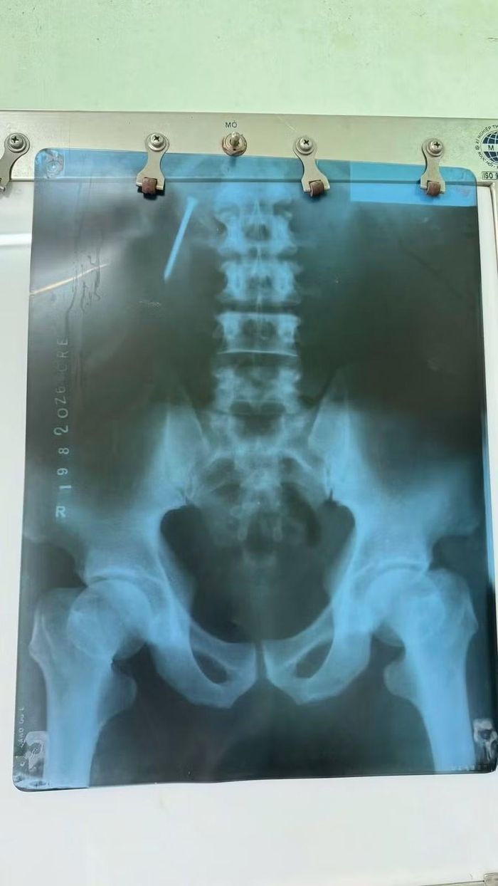 Hình ảnh X-quang cho thấy chiếc đinh 5 cm bị kẹt ở vùng thượng vị. Ảnh: ĐVCC