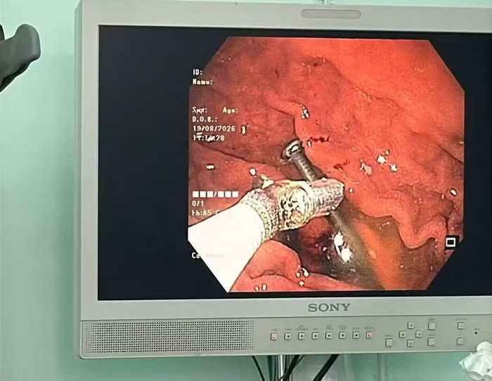 Các y, bác sĩ Bệnh viện Quân y 211 đã kịp thời lấy chiếc đinh ra, đảm bảo an toàn cho bệnh nhân. Ảnh: ĐVCC