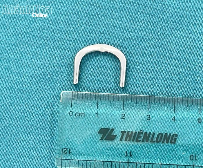 Dị vật được các bác sĩ Bệnh viện 22-12 nội soi lấy ra từ tá tràng của bệnh nhi.