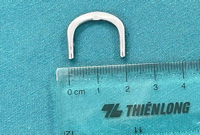 Móc khóa kim loại rộng 2cm đã được lấy ra khỏi tá tràng bệnh nhi.