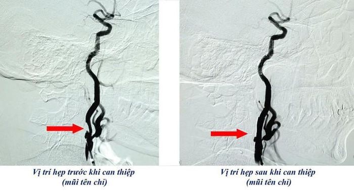 Hình ảnh chụp mạch số hóa xóa nền (DSA) trước và sau khi can thiệp. Ảnh: BVCC