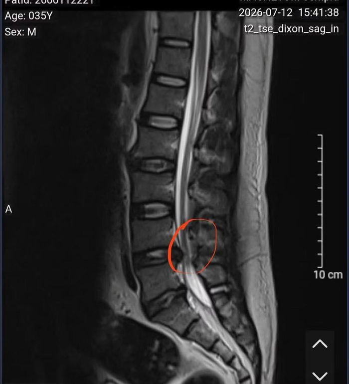 Hình ảnh thoát vị đĩa đệm L4-L5, chèn ép rễ thần kinh L5 cả hai bên trên phim chụp MRI - Ảnh BVCC