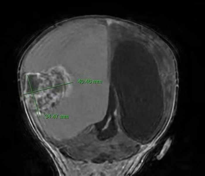 Hình ảnh chụp MRI cho thấy khối u não.