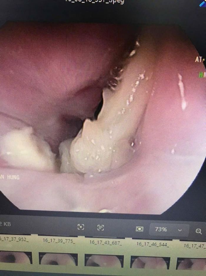 Hình ảnh dị vật là mảnh xương cá mắc tại thực quản bệnh nhân qua nội soi