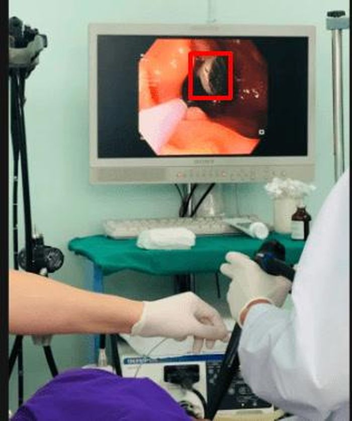 Nội soi phát hiện chiếc đinh đang mắc kẹt ở đoạn D2 tá tràng. Ảnh: Bệnh viện Quân y 211