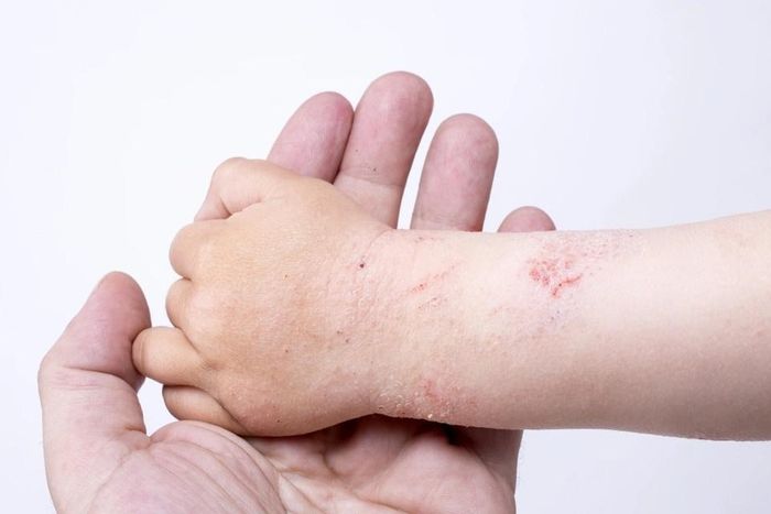 Viêm da dị ứng là một căn bệnh ảnh hưởng nghiêm trọng đến đời sống cũng như sinh hoạt hàng ngày. Ảnh: Shutterstock.