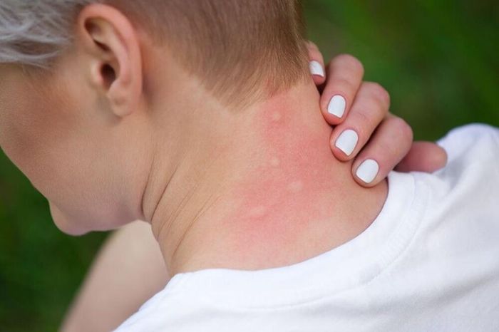 Ngày càng nhiều người bị dị ứng nặng do ô nhiễm môi trường. Ảnh minh họa: Everydayhealth