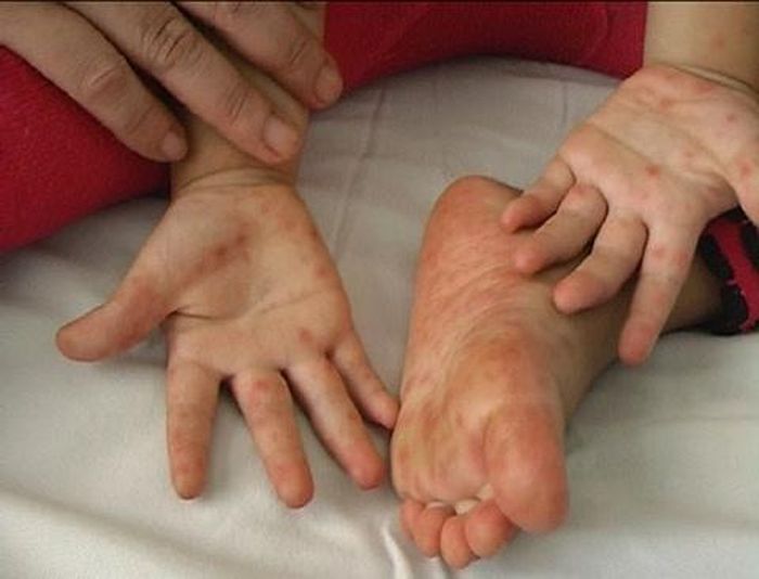  Trẻ mắc bệnh TCM cần được theo dõi sức khỏe thường xuyên và vệ sinh cơ thể. Ảnh: NGUYỄN MINH 