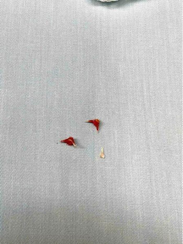 Sau hơn một giờ nội soi hô hấp, các bác sĩ đã lấy ra 3 mảnh xương lươn trong phế quản của bệnh nhi. Ảnh: BV