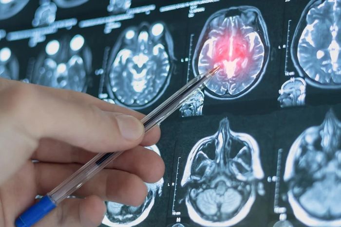 Các nhà khoa học Trung Quốc phát triển thành công mô hình AI phân tích hoạt động não, qua đó dự báo nguy cơ trầm cảm ở thanh thiếu niên. Ảnh minh họa: South China Morning Post