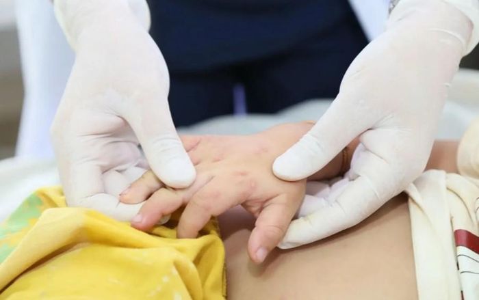 Dịch tay chân miệng vào mùa đúng dịp tựu trường.