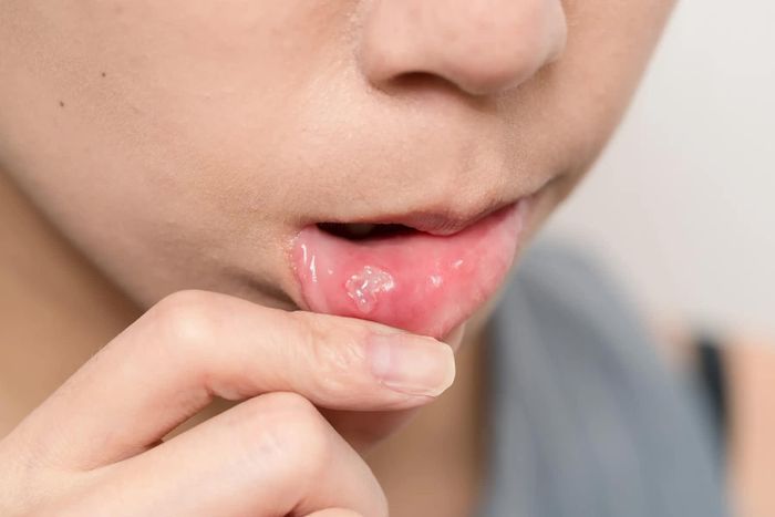 Bạn cần thận trọng với các mẹo giảm đau tại nhà